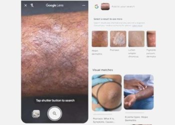 Google ile cildinizin fotoğrafından sorunu öğrenebileceksiniz!