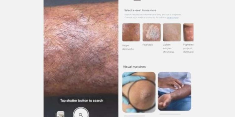 Google ile cildinizin fotoğrafından sorunu öğrenebileceksiniz!