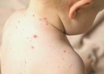 İTO’dan ‘kızamık’ açıklaması: Artışın nedeni sığınmacılar