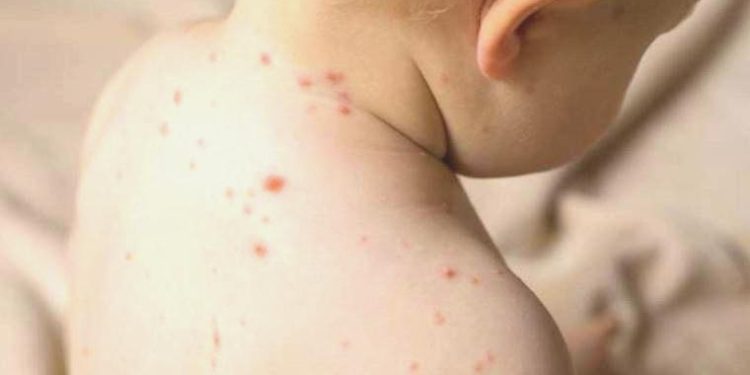 İTO’dan ‘kızamık’ açıklaması: Artışın nedeni sığınmacılar