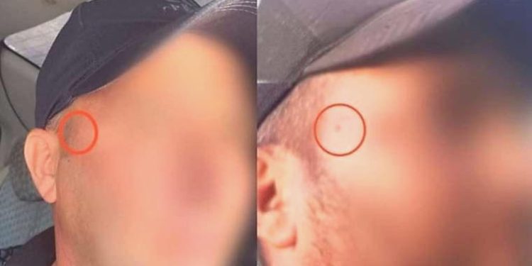 Jandarma dehşetinden yüzündeki beni aldırdı