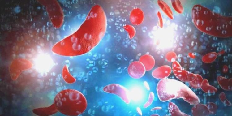 Orak hücre anemisi: Afrika’da çok sıkıntı gayret edilen genetik hastalık