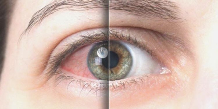 Prof. Dr. Demirci: Gözdeki kaşıntının altından demodeks çıkabilir