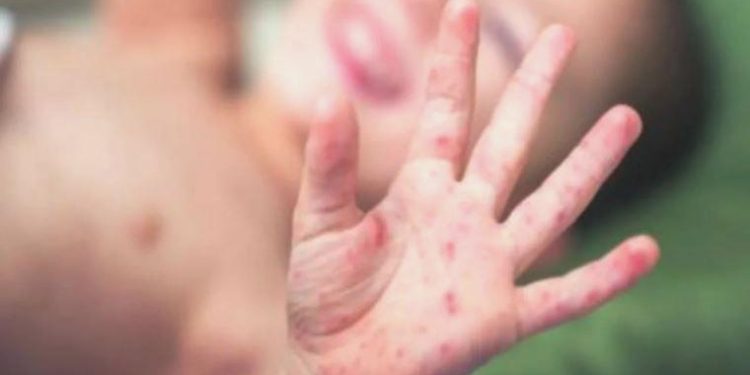 Prof. Dr. Esin Davutoğlu Şenol: Kızamığın nedeni aşı zıtlığı