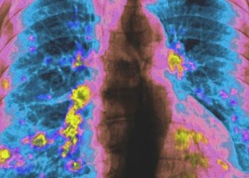 Yeni akciğer kanseri ilacı vefat riskini yarı yarıya azaltıyor