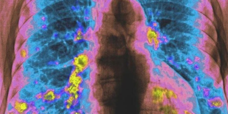 Yeni akciğer kanseri ilacı vefat riskini yarı yarıya azaltıyor