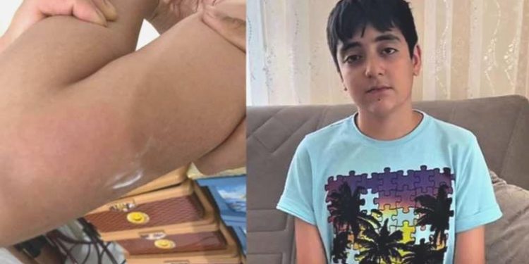 13 yaşındaki Yasin, balkona atılan torpille yaralandı