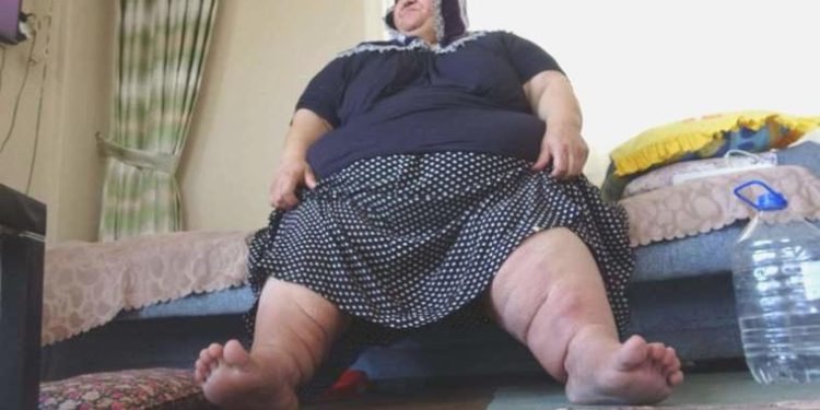 200 kiloya ulaşan fil hastası bayan, 7 yıldır konuttan çıkamıyor