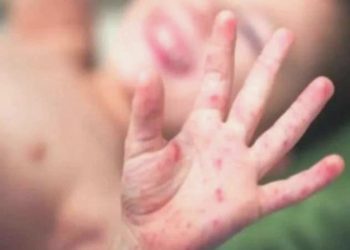 Çocuk sıhhati uzmanı uyardı: ‘Kızamık aşı ile önlenebilen önemli bir hastalık’