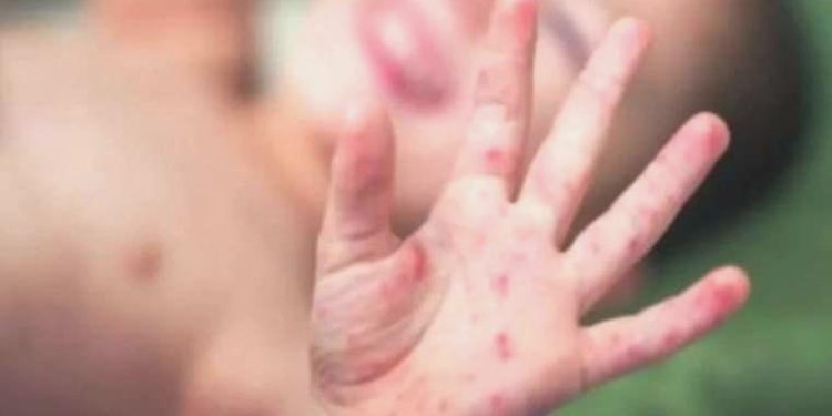 Çocuk sıhhati uzmanı uyardı: ‘Kızamık aşı ile önlenebilen önemli bir hastalık’