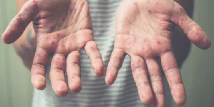 Dr. Ömer Faysal Çadır: Kızamık sorunu kapımıza dayandı