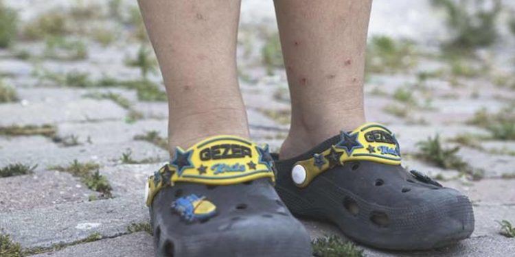 Sivrisinek yaraları nedeniyle hastanelere müracaatlar artıyor: ‘Isırmıyorlar, resmen koparıyorlar’