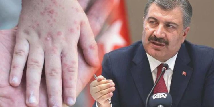 Son dakika… Kızamık olaylarında artış: Bakan Koca İstanbul’a dikkat çekti