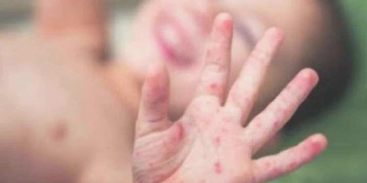 TEİS’ten kızamık hadiselerine karşı aşı uyarısı