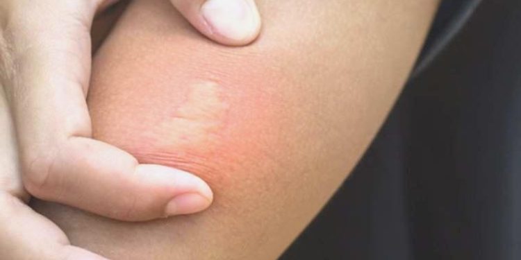 Arkadaşına yardım etmek istedi, arı sokması sonucu hayatını kaybetti