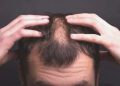 Işın Karaca’nın hastalığı ne? Alopesi Üniversalis hastalığı nedir, belirtileri neler? Alopesi Üniversalis hastalığı tedavisi var mı?