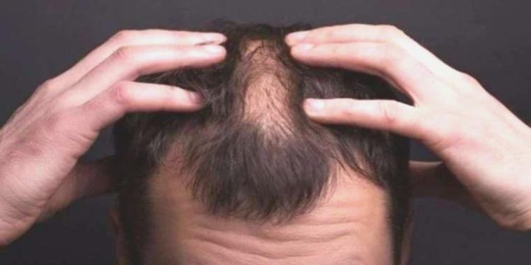 Işın Karaca’nın hastalığı ne? Alopesi Üniversalis hastalığı nedir, belirtileri neler? Alopesi Üniversalis hastalığı tedavisi var mı?