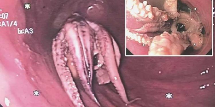 İstifra şikayetiyle gitti: Boğazından ahtapot çıktı