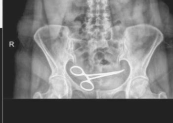 Karnında makas unuttular: 8 ay sonra fark edildi!