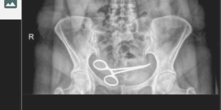 Karnında makas unuttular: 8 ay sonra fark edildi!