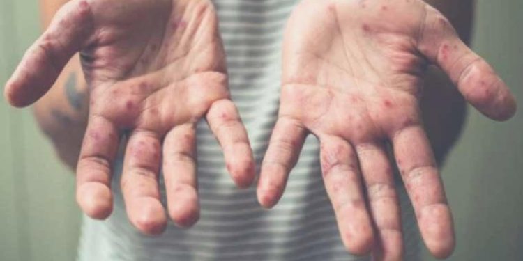 Kızamık hadiseleri her gün artıyor: İhtar var ancak aksiyon yok!