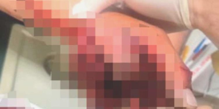 Nişanda ateşlediği havai fişek elinde patladı