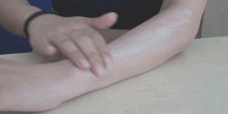 Uzmanı uyardı: Güneş yanıklarına konutta tedavi uygulanmamalı