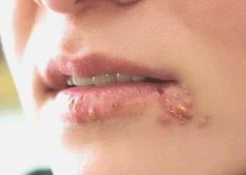 Uzmanı uyardı: Uçuk deyip geçmeyin!