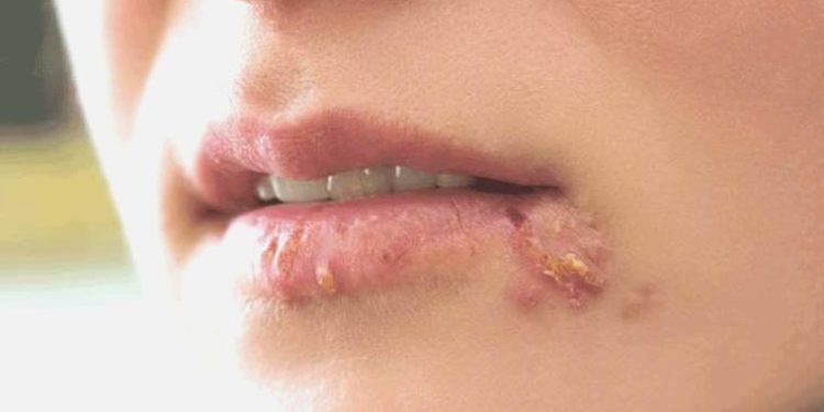 Uzmanı uyardı: Uçuk deyip geçmeyin!