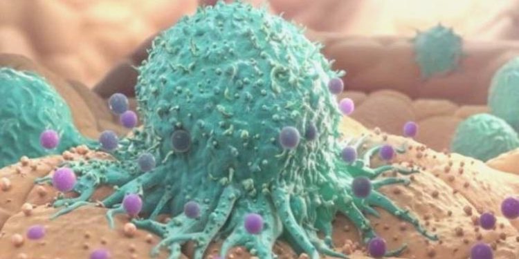 Kanser tedavisini zorlaştıran kilo ve kas kaybına tahlil