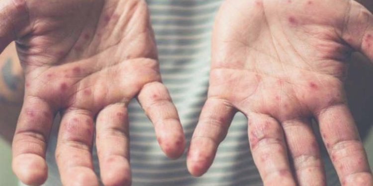 Kızamıkta ‘kış’ kaygısı: Canan Karatay gibiler yüzünden çocuklar aşılatılmıyor