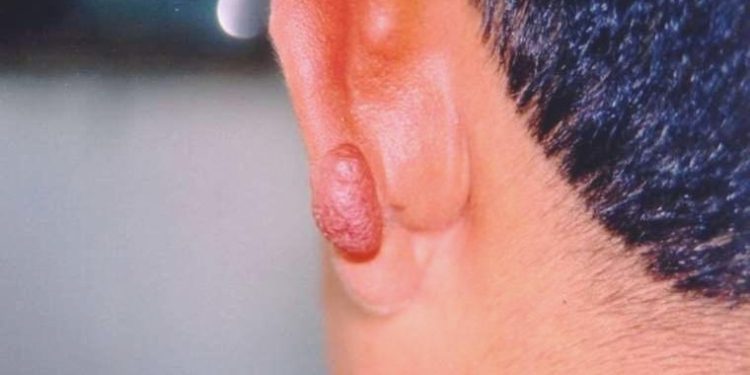 Uzmanından ‘kan emen kum sineği’ uyarısı: ‘Dalakta ve karaciğerde büyümeye neden oluyor’