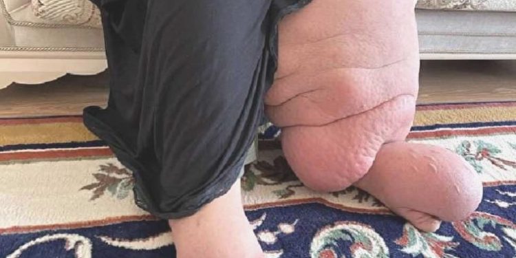 Fil Hastalığı (lenfödem) tedavisi nedir?