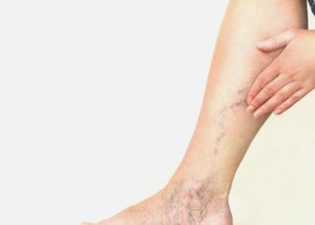 Uzmanı uyardı: ‘Yaz sıcakları varis sorunlarını artırıyor’