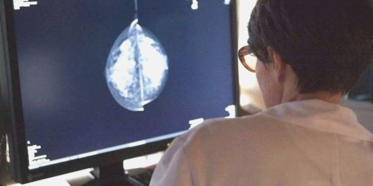 Yapay zeka göğüs kanseri tespitinde başarılı oldu