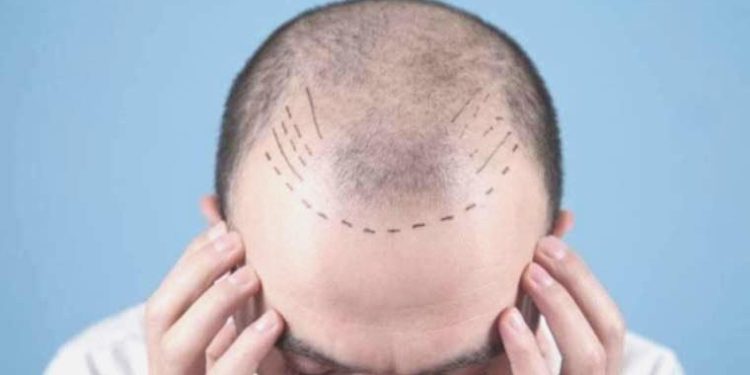 2023 Yılında En Çok Tercih Edilen Saç Ekim Merkezleri