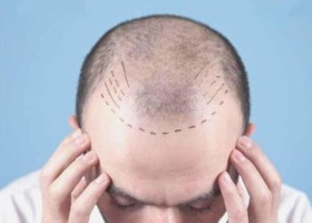 2023 Yılında En Çok Tercih Edilen Saç Ekim Merkezleri