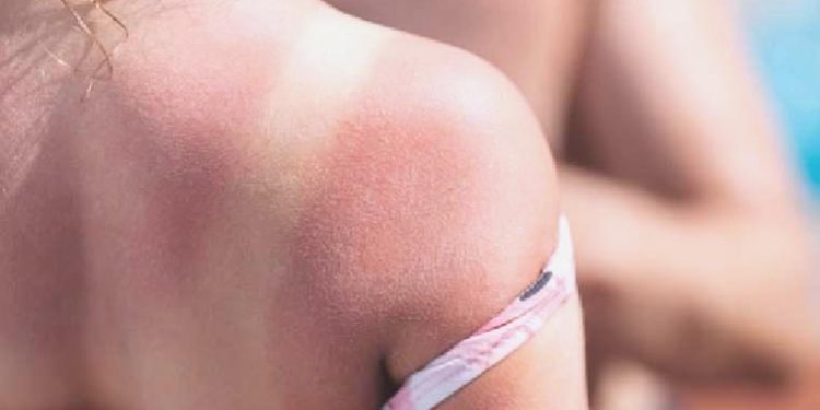 Deniz kum güneşin tehlikeli yanı: Güneş yanığı