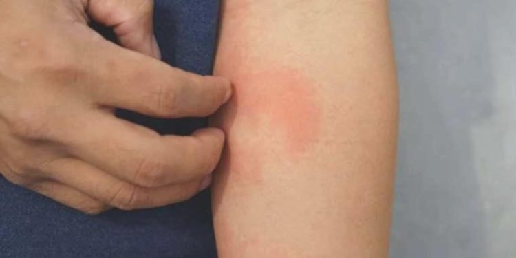 Güneş kremi kullanmayanlara makûs haber: Denetim altına alınmazsa döküntüler 2-3 ay sürebilir