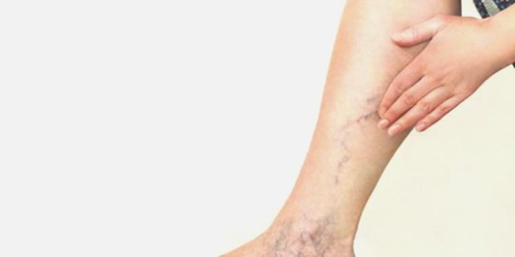 Sıcak havalar varis hastalığını tetikliyor