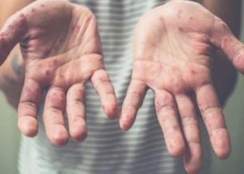 Sıhhat Bakanlığı’ndan ‘kızamık’ alarmı