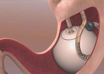 Tüp mide ameliyatı olanlar dikkat: Sıvı alımının değeri