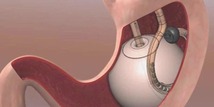 Tüp mide ameliyatı olanlar dikkat: Sıvı alımının değeri