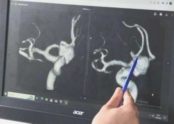 Uzmanlar anlattı: Beyin anevrizmasının tedavi süreci