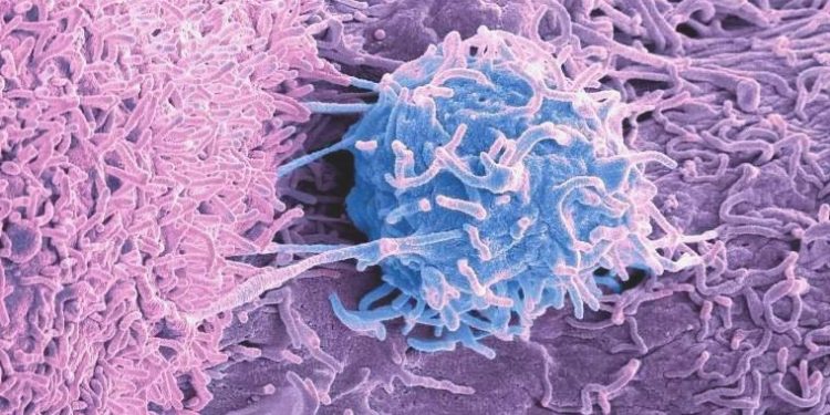 “Yaşam biçimi değişiklikleriyle kanser riski azaltılabilir”