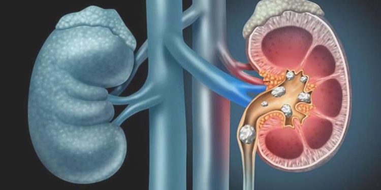 Böbrek taşı tedavisinin gözdesi: Flexible URS