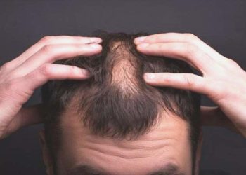 Saçkıran nedir? Belirtileri ve tedavi metotları