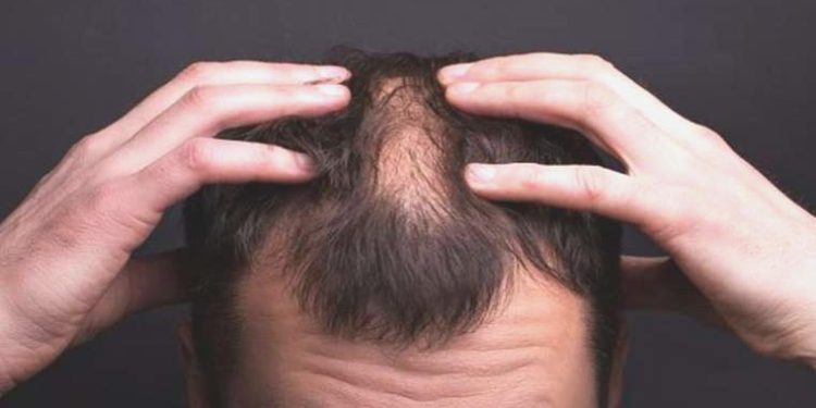 Saçkıran nedir? Belirtileri ve tedavi metotları