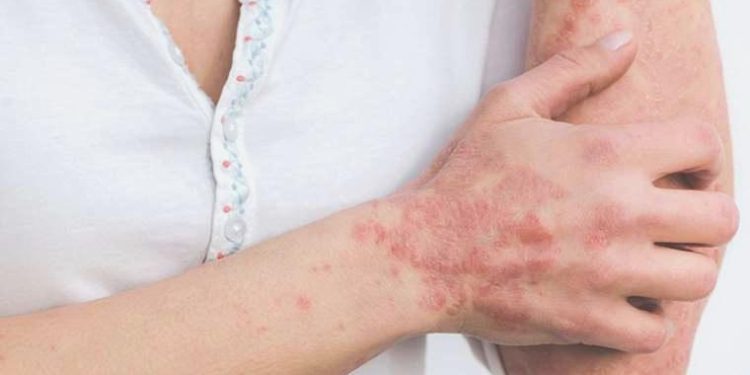 Sedef hastalığı hakkında bilmeniz gerekenler: Nedir? Belirtileri nelerdir?