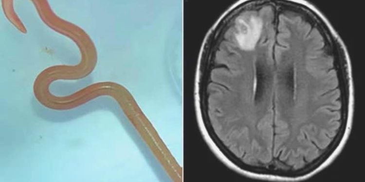 Beyninden çıkan şey herkesi şoke etti: Dünyada bir birinci olarak kaydedildi!